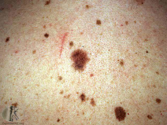 DERMATOLOGY TEACHING ONLINE: BENIGN AND MALIGNANT MELANOCYTIC LESIONS